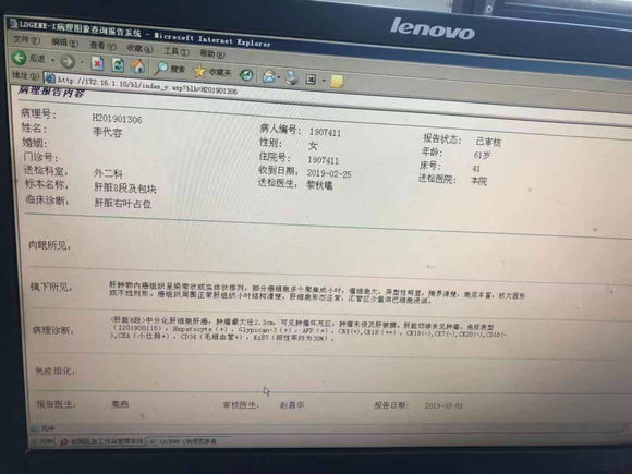肝癌伴随肝硬化术后病理结果
