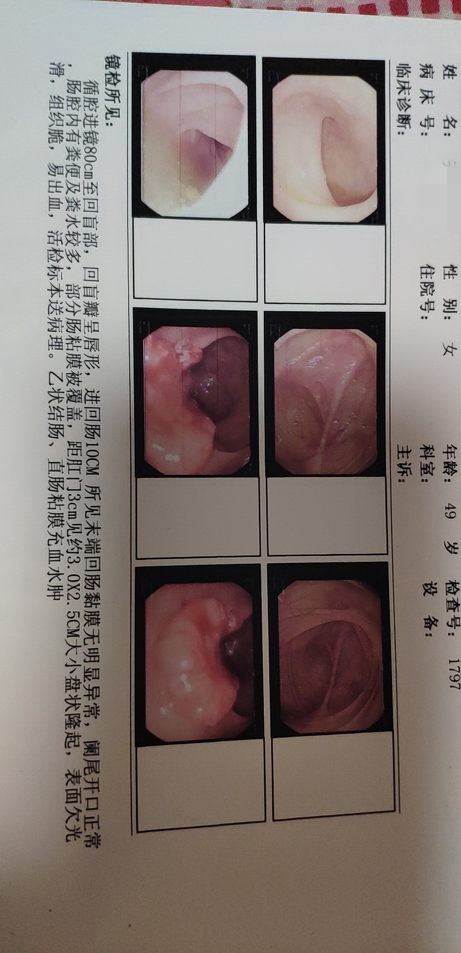 病理还没出来大夫说是直肠癌会不会误诊呀