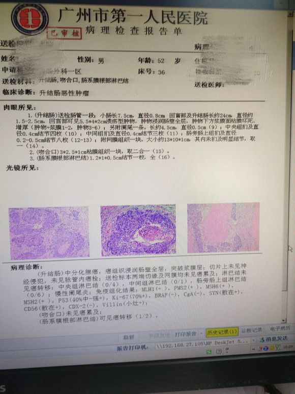 结肠癌3b期，化疗后能治愈吗？