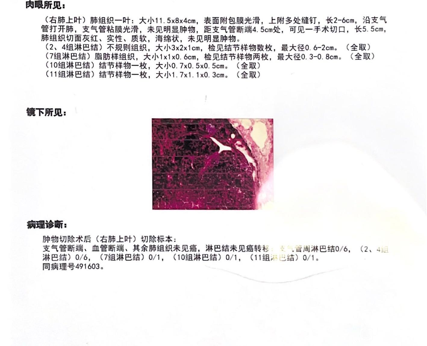 肺腺癌（粘液腺癌）1a2期无高危需要做基因检测吗